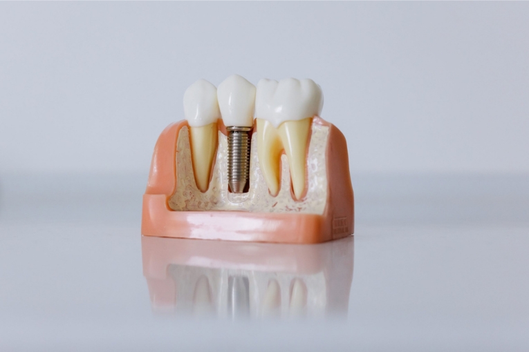 Maqueta de implantes dentales con corona sobre tornillo de titanio entre dientes naturales.