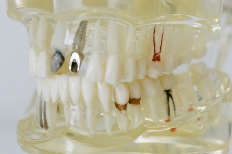 Modelo dental transparente con implantes y piezas dentales, representativo de odontología restauradora.