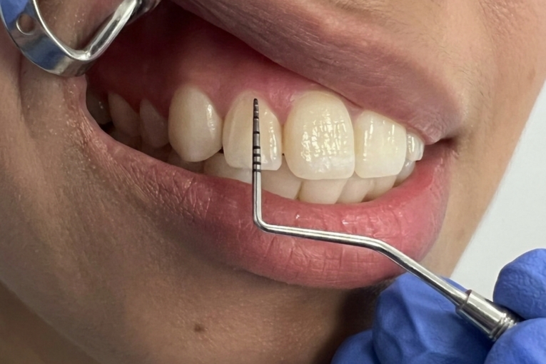 Sonda periodontal midiendo la encía entre incisivos en una revisión de periodoncia.